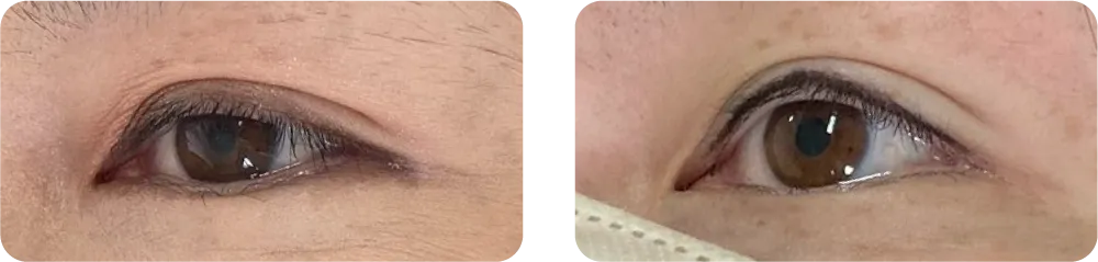 長崎 アイラインアートメイク 症例 ビフォーアフター 40代女性